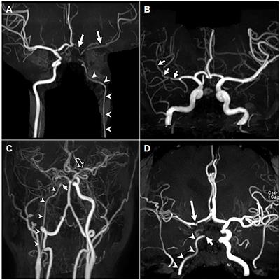 Proliferative Vasculopathy Associated With Antiphospholipid Antibodies in Patients With Neurological Symptoms